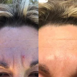 Vorher-Nachher-Nahaufnahme der Stirn mit sichtbar reduzierten Falten nach Chi statt Botox