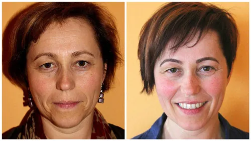 Vorher-Nachher-Bild einer Frau mit Chi statt Botox: links ernster Blick, rechts lächelnd mit frischerer Haut